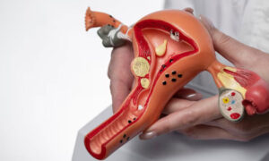 Miom Uterine Fibroid